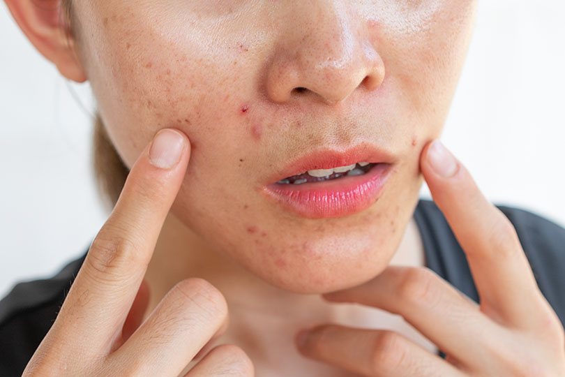 Kako se riješiti prištića?